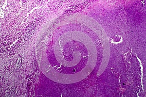 Caseation of human tuberculosis granuloma, light micrograph