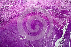 Caseation of human tuberculosis granuloma, light micrograph