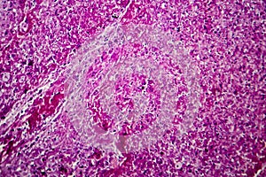 Caseation of human tuberculosis granuloma, light micrograph