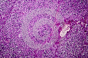 Caseation of human tuberculosis granuloma, light micrograph