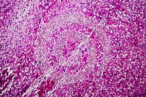 Caseation of human tuberculosis granuloma, light micrograph