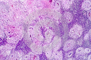 Caseous necrosis of lymphatic node