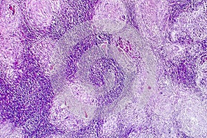 Caseous necrosis of lymphatic node