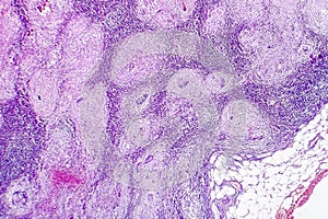 Caseous necrosis of lymphatic node