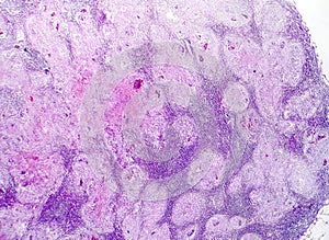 Caseous necrosis of lymphatic node