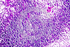 Caseous necrosis of lymphatic node