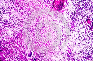 Caseous necrosis of lymphatic node