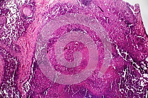Caseous pneumonia, light micrograph