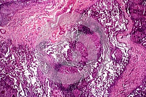 Caseous pneumonia, light micrograph