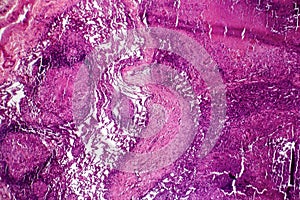 Caseous pneumonia, light micrograph