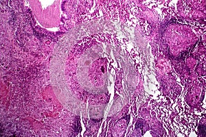 Caseous pneumonia, light micrograph