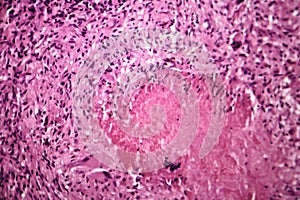 Caseous pneumonia, light micrograph