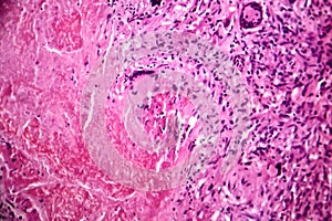 Caseous pneumonia, light micrograph