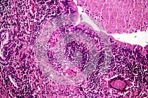 Caseous pneumonia, light micrograph