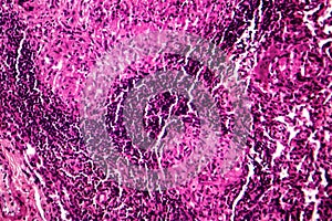 Caseous pneumonia, light micrograph