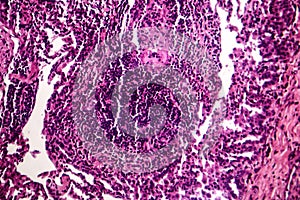 Caseous pneumonia, light micrograph