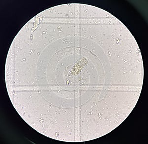 Cast in fresh urine finding with microscope