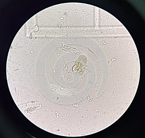 Cast in fresh urine finding with microscope