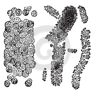 Cast made up almost purely of leukocytes, cast composed of acid sodic urate, vintage engraving