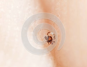 Castor bean tick, Ixodes ricinus feeding on human skin