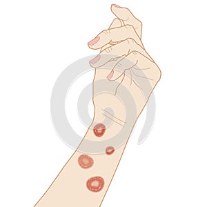 Cat fungus on the arm, allergy dermatitis, illustration on white background