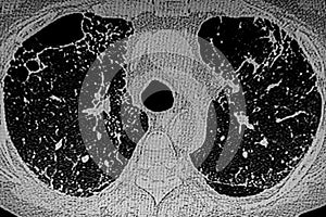 CAT- Scan of interstitial lung disease secondary to scleroderma.