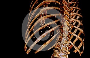 CAT -SCAN of rib fracture photo