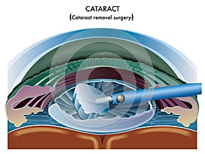 Cataract