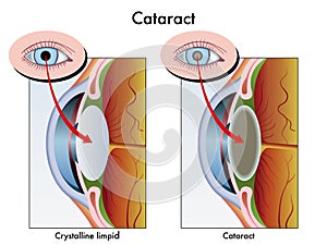 Cataract
