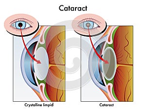 Cataract photo