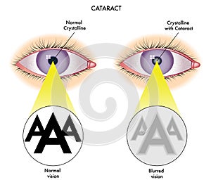 Cataract