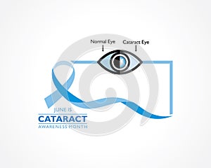 Cataract Awareness Month observed in June, It is a dense, cloudy area that forms in the lens of the eye