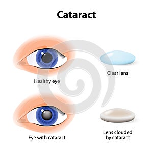 A cataract is an clouding crystalline lens