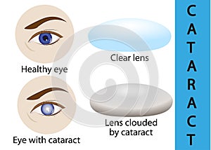 A cataract is an clouding crystalline lens inside the eye. photo