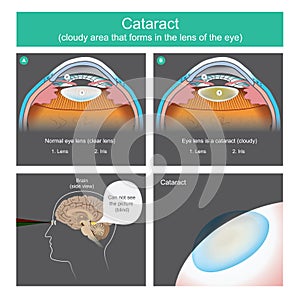 Cataract is a dense cloudy area that forms in the lens of the eye