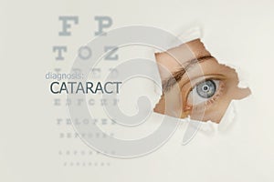 Cataract disease poster wwith eye test chart and blue eye on right.