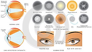 Cataract photo