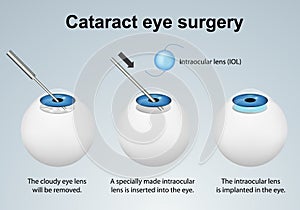 Cataract eye surgery process medical vector illustration isolated on grey background