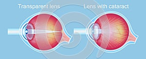 Cataract Eyes Icon Vector.