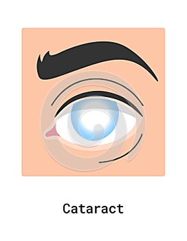 Cataract Human Eye Disease