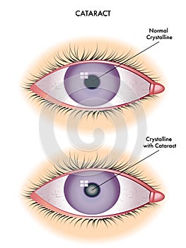 Cataract