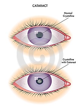 Cataract photo