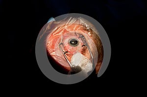 Cataract before ophthalmologic surgery