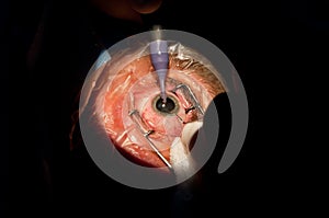 Cataract ophthalmologic surgery