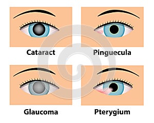 Cataract, Pinguecula, Glaucoma and Pterygium, eye care