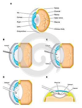 Cataract removal