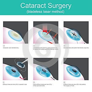 Cataract Surgery bladeless laser method. photo