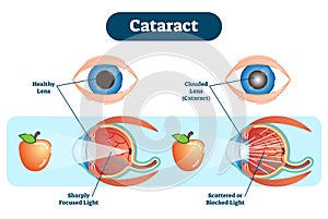 Cataract vector illustration diagram, anatomical scheme.