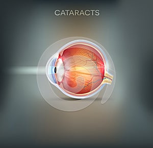 Cataracts abstract grey background photo