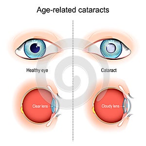 Cataracts. Age-related vision problems